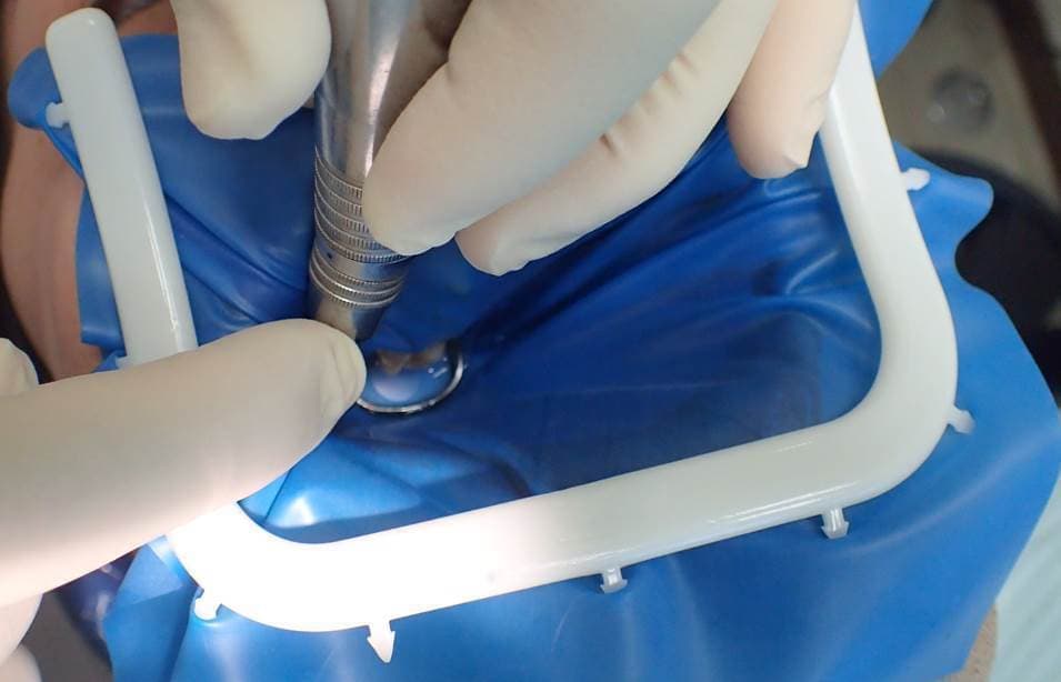 ラバーダムを装着した治療風景