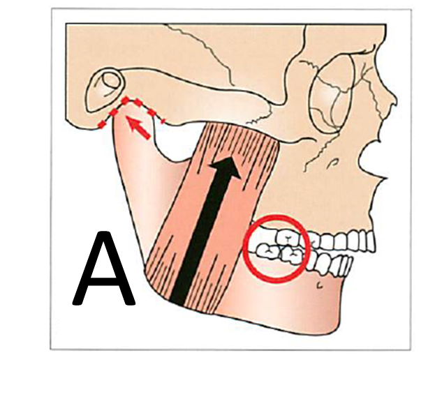 臼歯部の早期接触