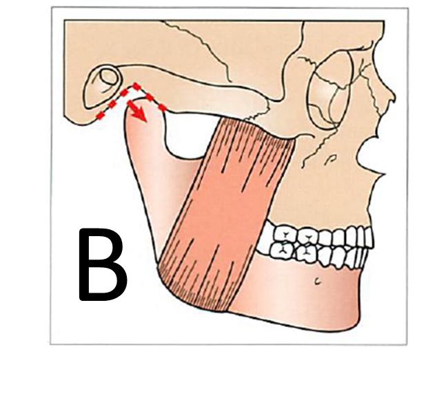 中心位がずれた最大嵌合位